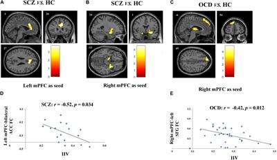 Resting-State Default Mode Network Related Functional Connectivity Is Associated With Sustained Attention Deficits in Schizophrenia and Obsessive-Compulsive Disorder